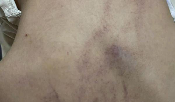 Bộ Y tế vào cuộc, trưng cầu giám định bé 4 tuổi bị cô giáo bạo hành