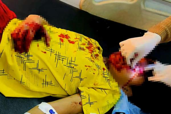 Điện thoại phát nổ khi đang sạc, một học sinh bị thương