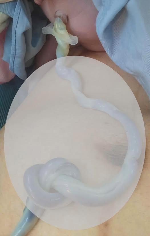 Xử trí thành công trường hợp sinh thường có dây rốn thắt nút hiếm gặp