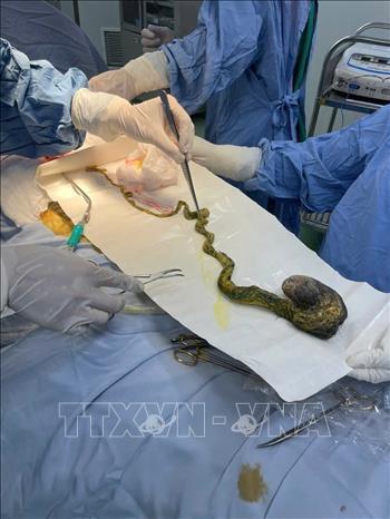 Cảnh báo bệnh lý nguy hiểm do hành vi ăn tóc ở trẻ em