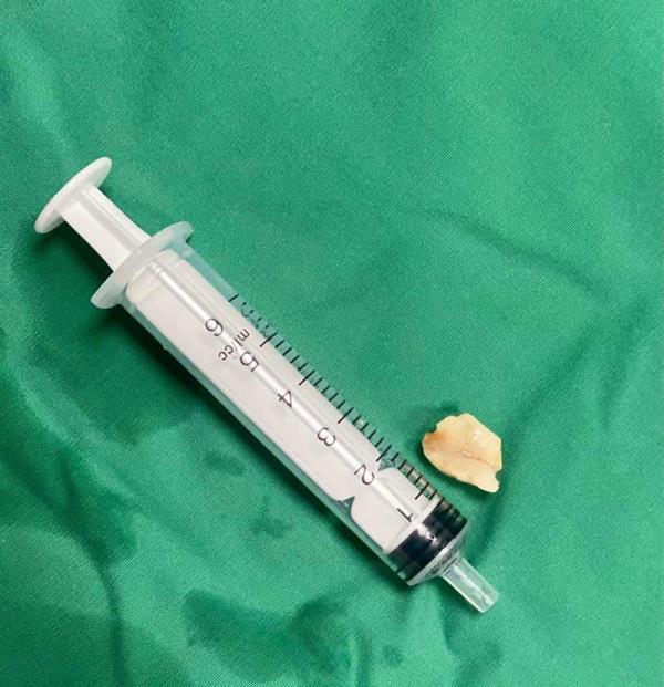 Hạt lạc lạc trong phế quản