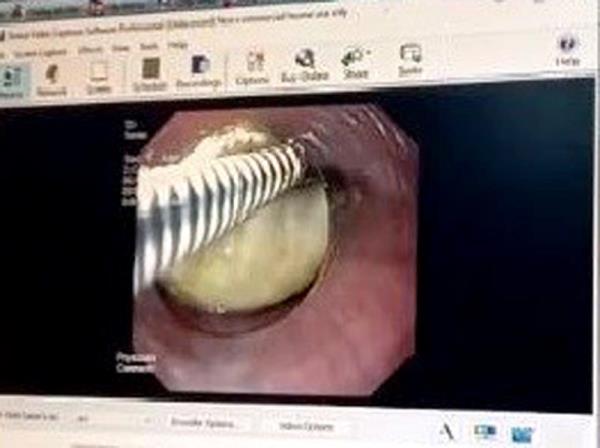 Kịp thời cứu sản phụ tự ý nuốt mật lợn để chữa đau bụng