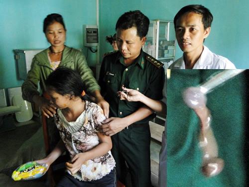 Gắp 2 con vắt dài 7cm nằm trong mũi 